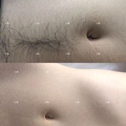 -小梨专业脱毛连锁机构