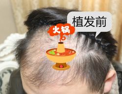 -大麦微针植发全国连锁