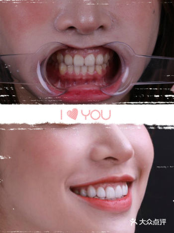 树脂贴面和瓷贴面有什么区别？