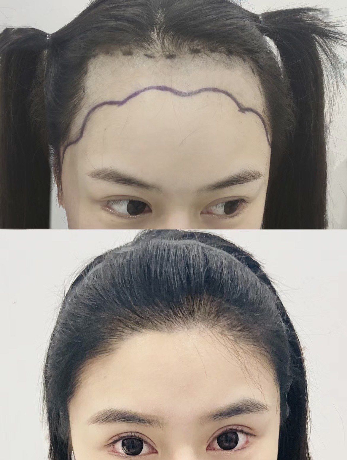 女士花瓣型发际线术后效果