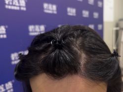 -碧莲盛·不剃发植发