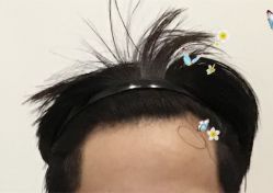 -大麦微针植发全国连锁