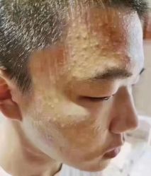 -瑶芳清颜草本祛痘