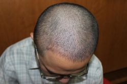 点击看大图 -大麦微针植发丨全国连锁