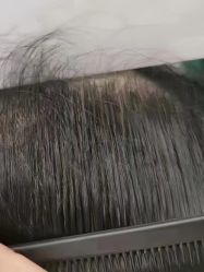 -菩叶脱发白发中心