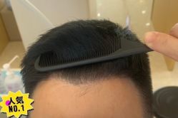 -大麦微针植发丨全国连锁