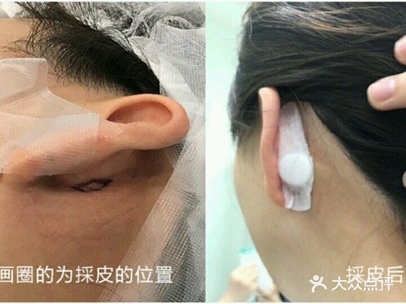 肌肤回春大法，纤维芽细胞培养回输公开！