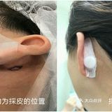 肌肤回春大法，纤维芽细胞培养回输公开！