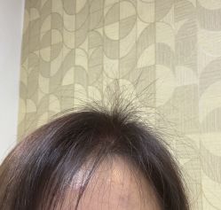 -大麦微针植发全国连锁