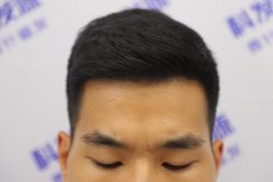 -大麦微针植发丨全国连锁