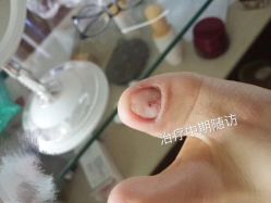 -德哥灰指甲脚气甲沟炎跖疣护理