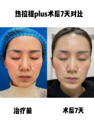 -蚌埠国色医疗美容医院•眼鼻整形