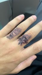 -一次性洗纹身·修复疤痕·超皮秒