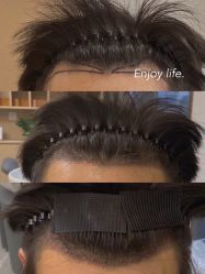 体验前-东莞缔美美容医院