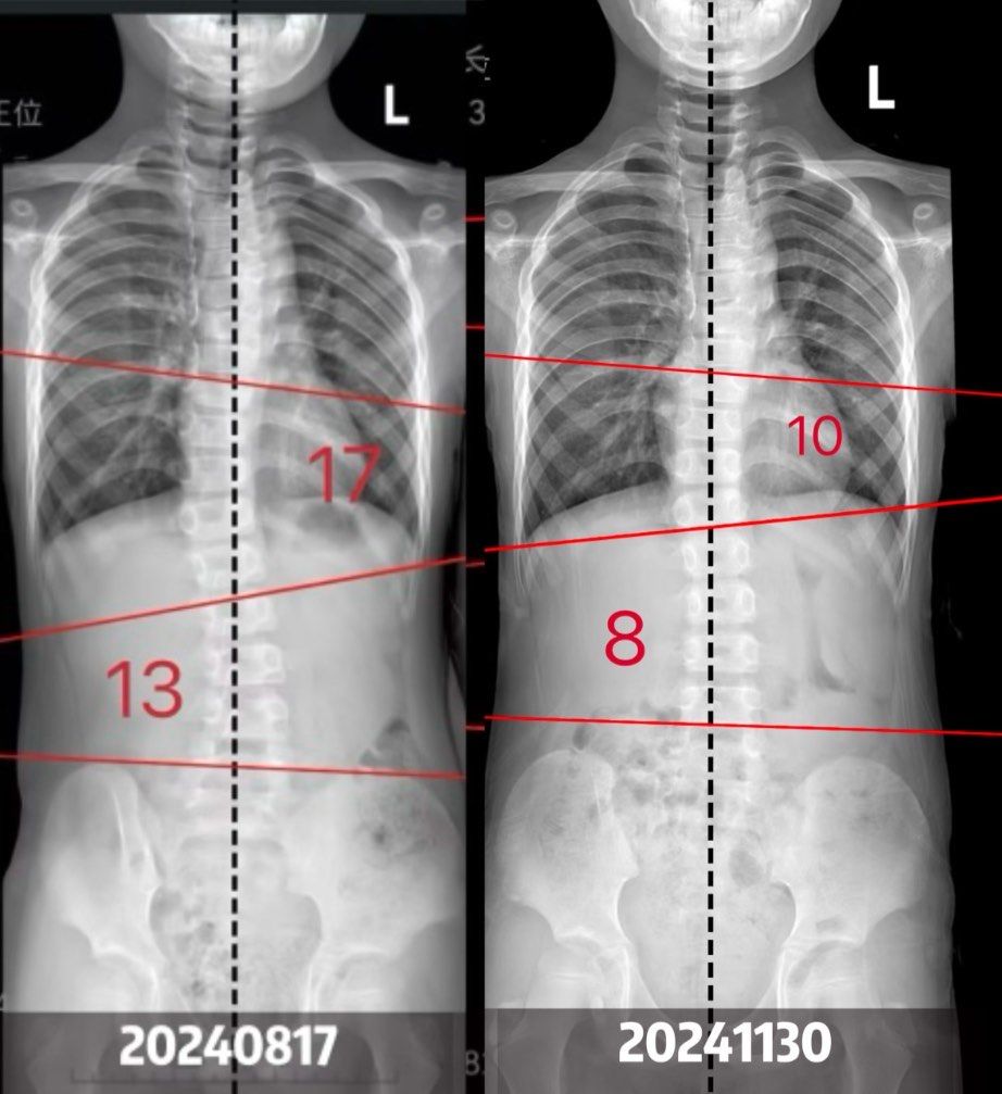 成长轨迹:骨骼x光对比