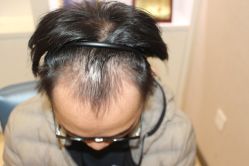 点击看大图 -大麦微针植发丨全国连锁