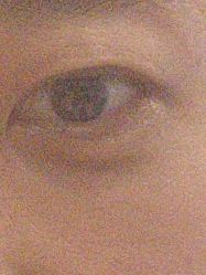 -广州健丽·去眼袋医疗美容机构