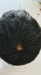 -大麦微针植发全国连锁