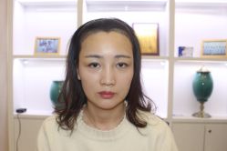 点击看大图 -大麦微针植发丨全国连锁