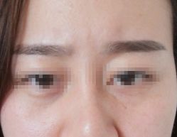 体验前-新美荟医美·专注面部美学抗衰