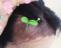 -大麦微针植发全国连锁