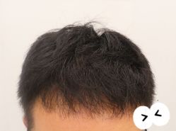 -大麦微针植发全国连锁