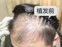 -大麦微针植发全国连锁