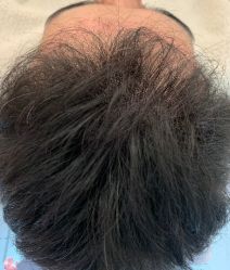 -大麦微针植发丨全国连锁