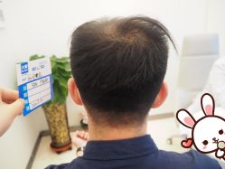 -大麦微针植发丨全国连锁