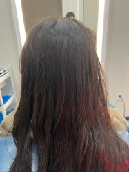 体验后-大麦微针植发全国连锁