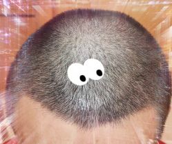 -大麦微针植发全国连锁