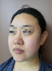 体验前-More摩尔医美の注射线雕光电中心