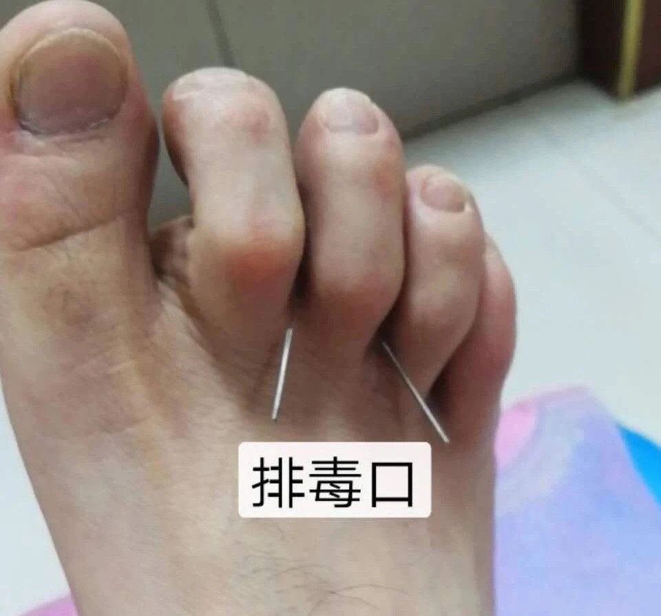 把中趾的排毒点打开,排毒点位置在中趾赤白肉际边缘