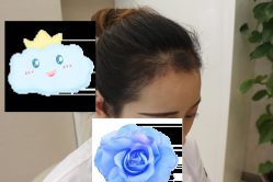-大麦微针植发丨全国连锁