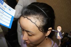 -大麦微针植发丨全国连锁