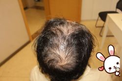 -大麦微针植发丨全国连锁