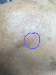 体验后-爱莎扁平疣·汗管瘤·斑痣中心