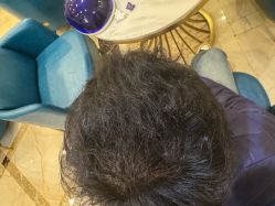 -碧莲盛·不剃发植发