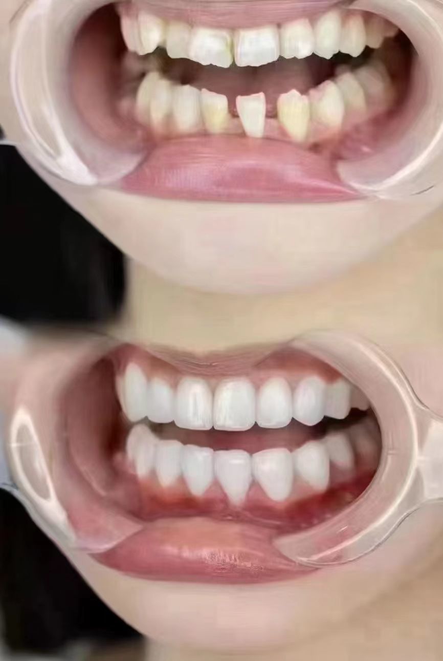 亮白牙齿自然闪耀