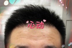 -大麦微针植发全国连锁