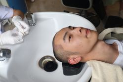 点击看大图 -大麦微针植发丨全国连锁