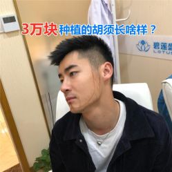 点击看大图 -碧莲盛·不剃发植发