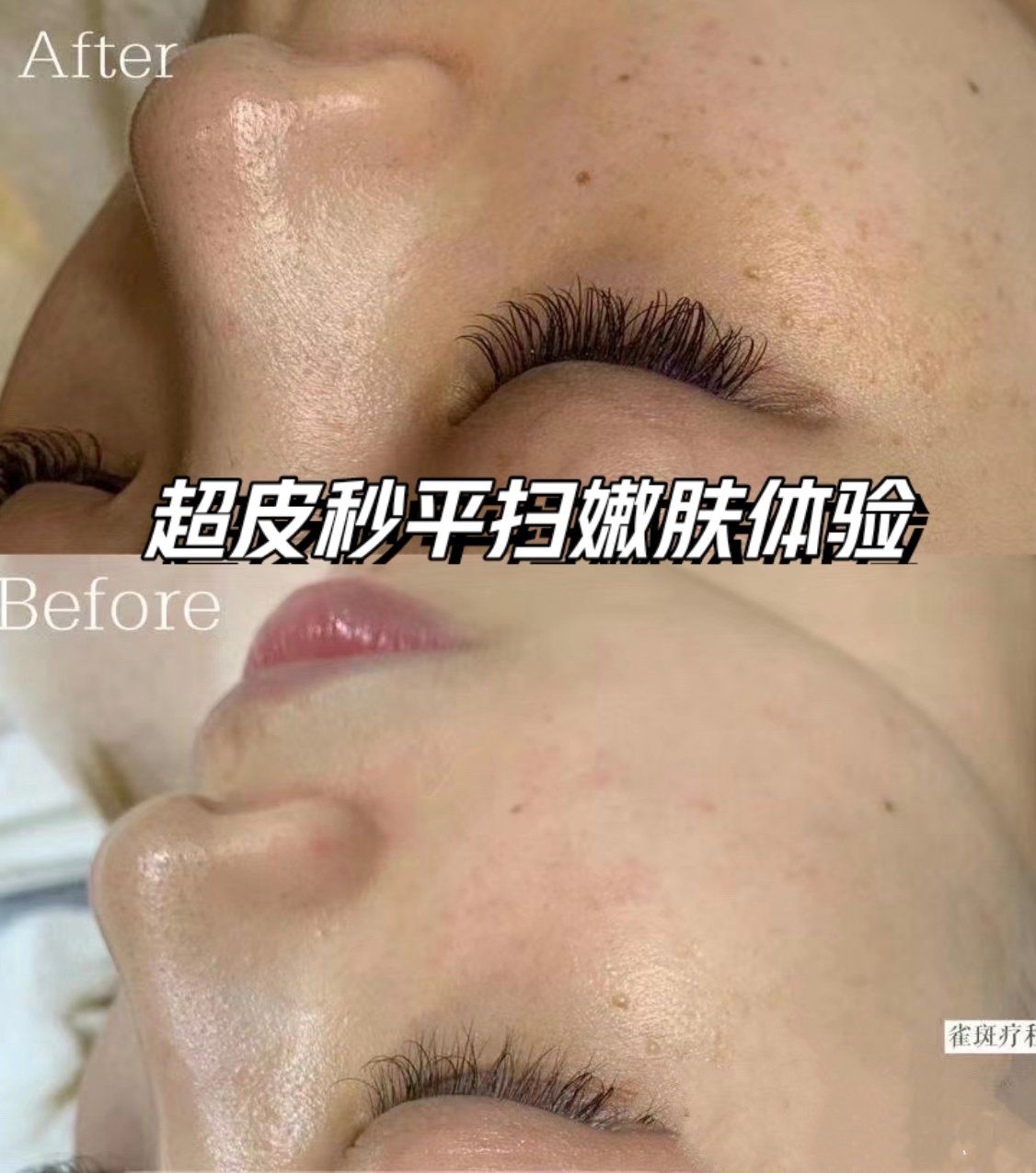 7天变美记,超皮秒平扫嫩肤体验