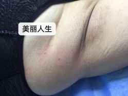 -爱莎扁平疣·汗管瘤·斑痣中心