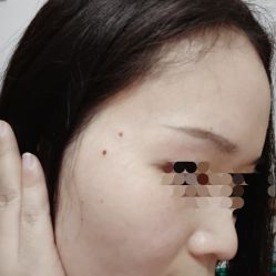 -痣缘宫