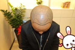 点击看大图 -大麦微针植发丨全国连锁