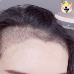 -大麦微针植发丨全国连锁