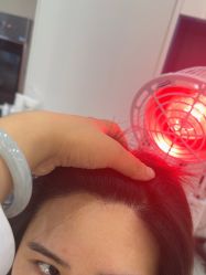 -大麦微针植发全国连锁