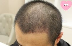 -大麦微针植发丨全国连锁