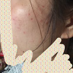 -成都苗方清颜专业祛痘